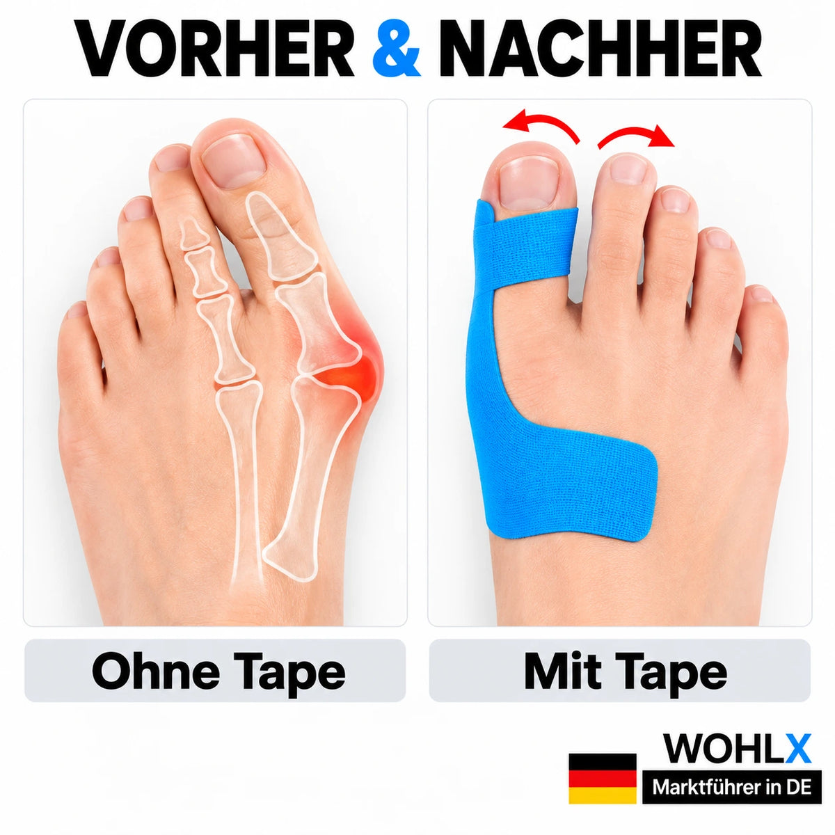 Hallux Valgus Tapes
